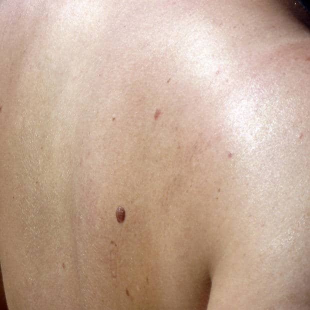 skin-cancer-signs-on-back